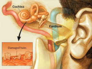 Diagram of the ear, from the eardrum to the cochlea, showing enlarged image of cochlear damage (damaged hair cells)..